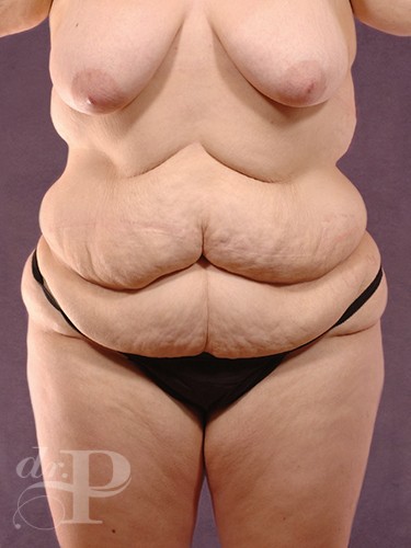 Case--29178 | Before Liposuction 1