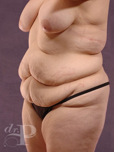 Case--29178 | Before Liposuction 2