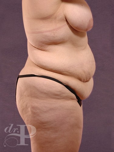 Case--29174 | Before True Form Tummy Tuck® in Overweight & Weight Loss Patients 5