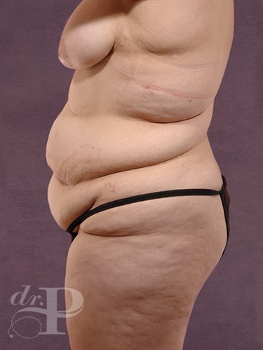 Case--29180 | Before Lower Body Lift (Buttock Lift) 3