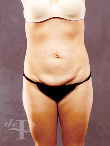 Case--1424 | Before True Form Tummy Tuck® 1