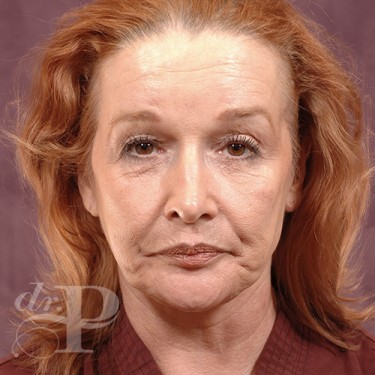 Case--29839 | Before Cosmetic Injectables 1