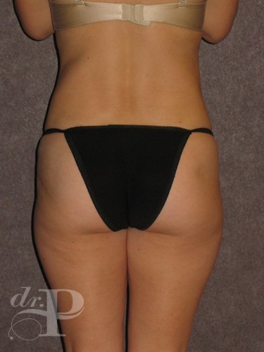 Case--1301 | After Liposuction 4