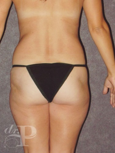 Case--1291 | Before True Form Tummy Tuck® 4