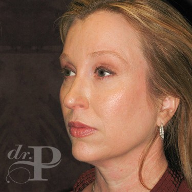 Case--29786 | After Cosmetic Injectables 2