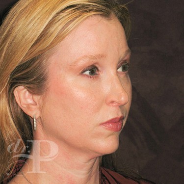 Case--29786 | After Cosmetic Injectables 4