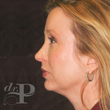 Case--29786 | After Cosmetic Injectables 3