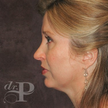 Case--29786 | Before Cosmetic Injectables 3