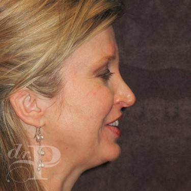 Case--29786 | Before Cosmetic Injectables 5