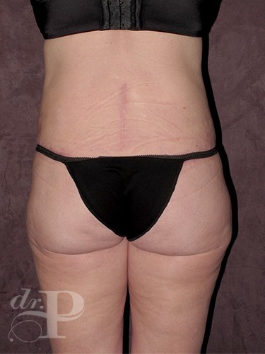 Case--28375 | After True Form Tummy Tuck® with Lower Body Lift (Buttock Lift) 4