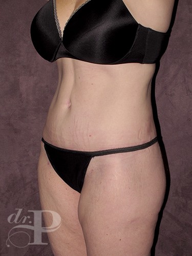 Case--28373 | After Lower Body Lift (Buttock Lift) 2
