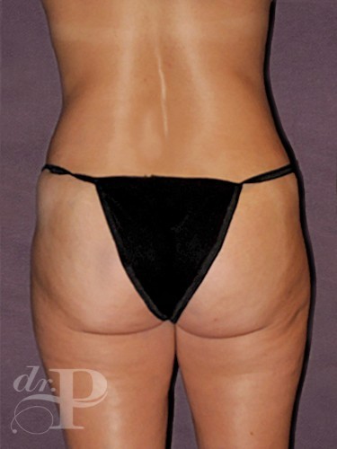 Case--2017 | After True Form Tummy Tuck® 4