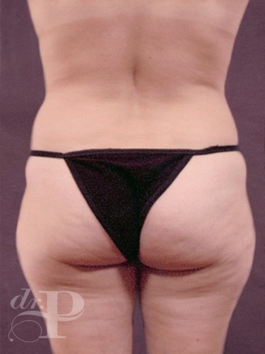 Case--2005 | Before Liposuction 4