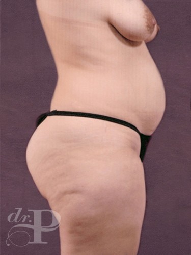 Case--2017 | Before True Form Tummy Tuck® 3