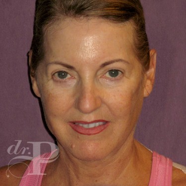 Case--29560 | After Facelift and Neck Lift 1