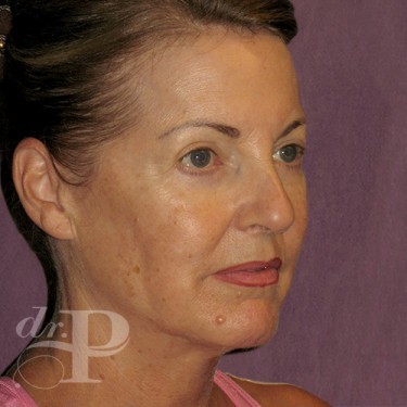 Case--29560 | After Facelift and Neck Lift 4