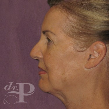 Case--29560 | After Facelift and Neck Lift 3