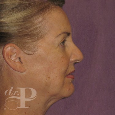 Case--29560 | After Facelift and Neck Lift 5