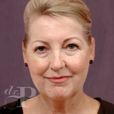 Case--29560 | Before Facelift and Neck Lift 1