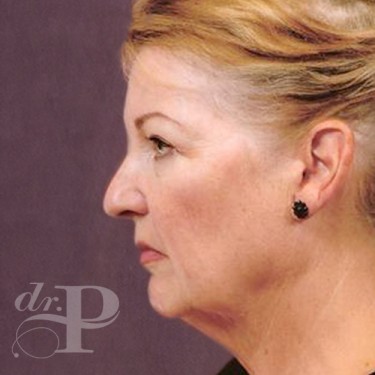 Case--29560 | Before Facelift and Neck Lift 3