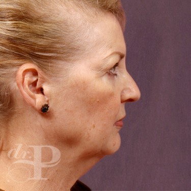Case--29560 | Before Facelift and Neck Lift 5