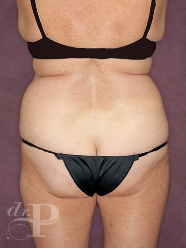 Case--28782 | Before Lower Body Lift (Buttock Lift) 3