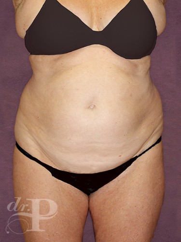 Case--28785 | Before True Form Tummy Tuck® with Lower Body Lift (Buttock Lift) 1