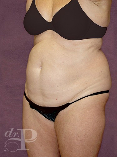 Case--837 | Before True Form Tummy Tuck® in Overweight & Weight Loss Patients 2