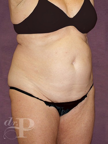 Case--28782 | Before Lower Body Lift (Buttock Lift) 4