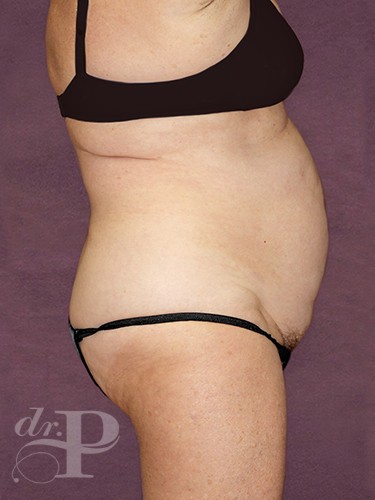 Case--28785 | Before True Form Tummy Tuck® with Lower Body Lift (Buttock Lift) 5