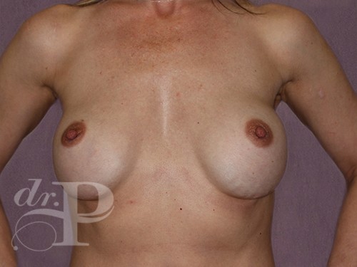 Case--28103 | Before Corrective/Revision Breast Implant Surgery 1