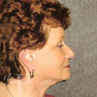 Case--30208 | After Facelift and Neck Lift 2