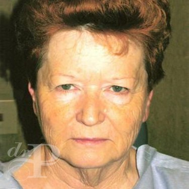 Case--30208 | Before Facelift and Neck Lift 1