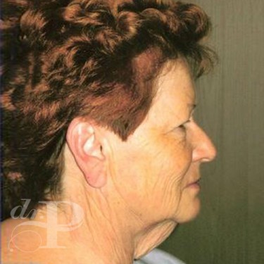 Case--30208 | Before Facelift and Neck Lift 2