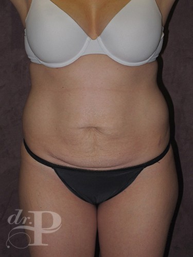 Case--1442 | Before Liposuction 1