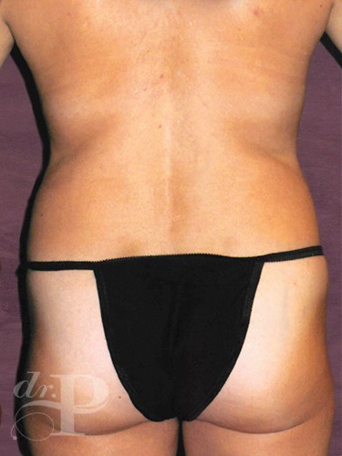 Case--1177 | Before Liposuction 4