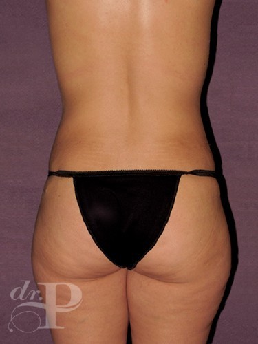 Case--1048 | After True Form Tummy Tuck® 4
