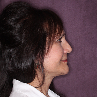 Case--34893 | After Brow Lift 4