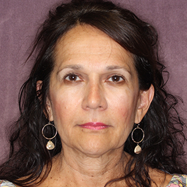Case--34893 | Before Brow Lift 1