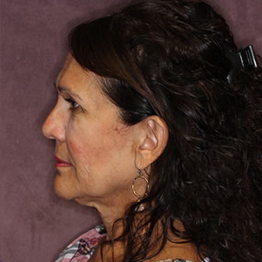 Case--34893 | Before Brow Lift 5