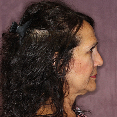 Case--34893 | Before Brow Lift 4