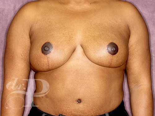 Case--28291 | After Breast Lift 1