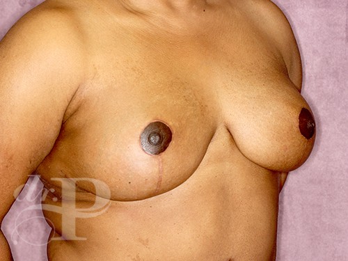 Case--28291 | After Breast Lift 3