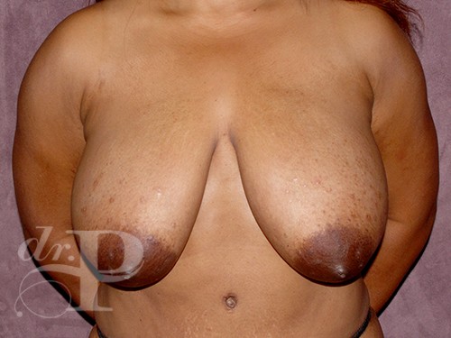 Case--28291 | Before Breast Lift 1