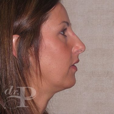 Case--28455 | Before Nose Surgery (Rhinoplasty) 5