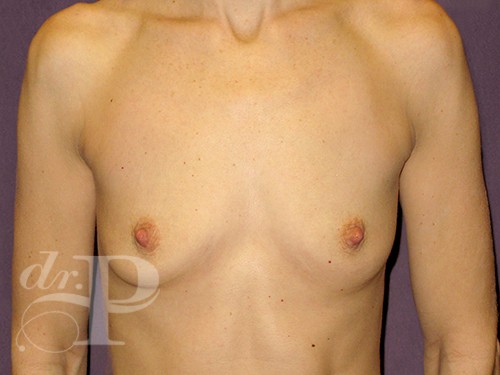 Case--28699 | Before Breast Augmentation 1