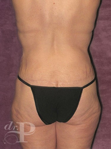 Case--29746 | After True Form Tummy Tuck® in Overweight & Weight Loss Patients 4