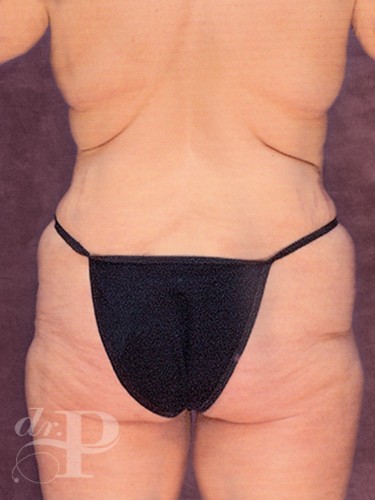 Case--29746 | Before True Form Tummy Tuck® in Overweight & Weight Loss Patients 4