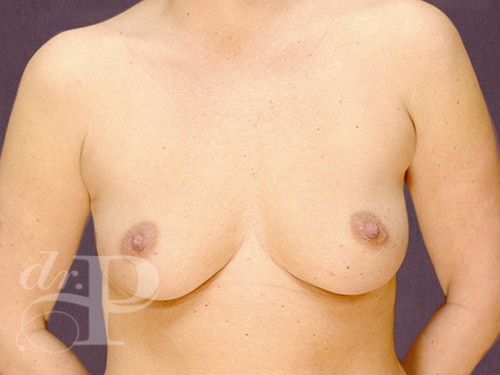 Case--28604 | Before Breast Augmentation 1