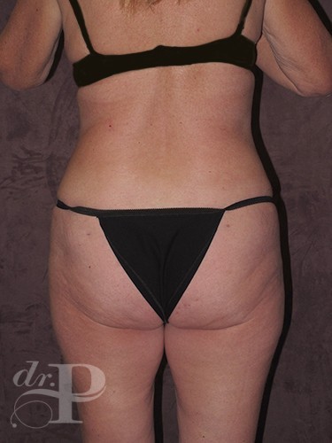 Case--1668 | After Liposuction 4